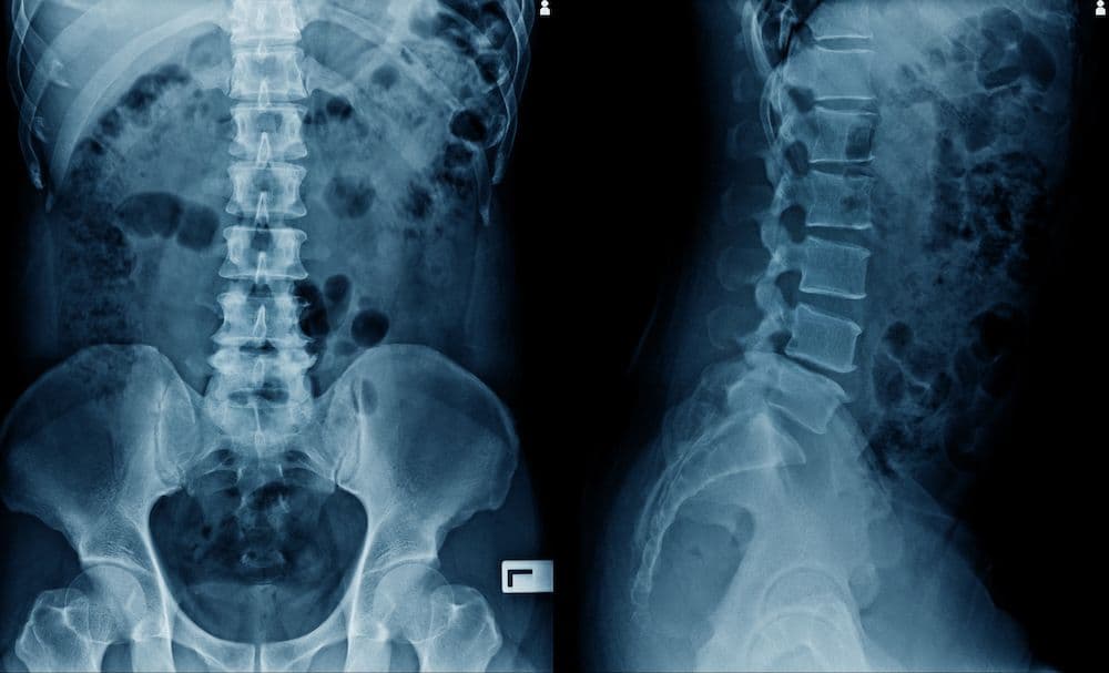 Digital spine x-ray for custom care plan at CornerStone Chiropractic in Minot, North Dakota
